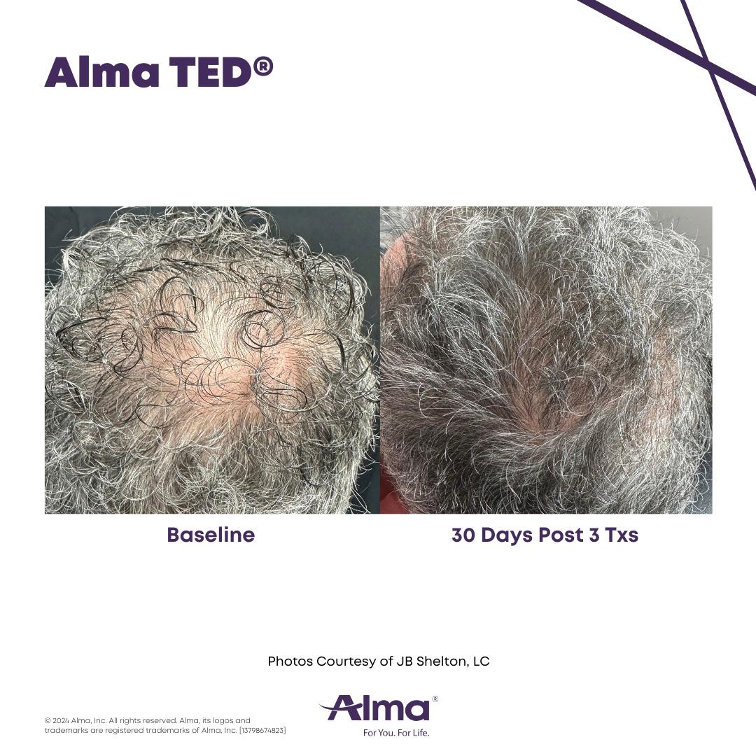 Alma TED Hair Restoration Results 1