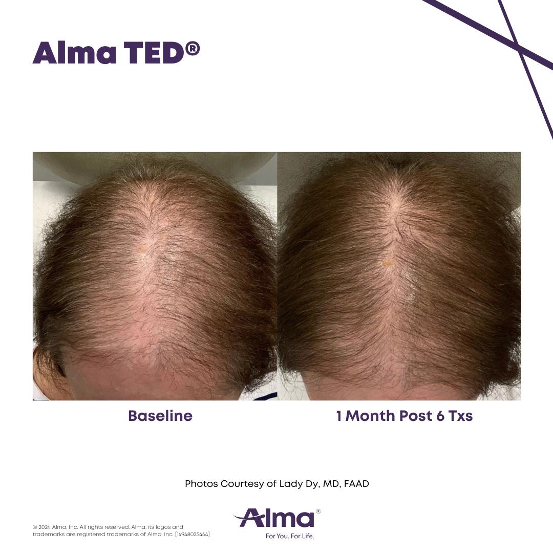 Alma TED Hair Restoration Results 2