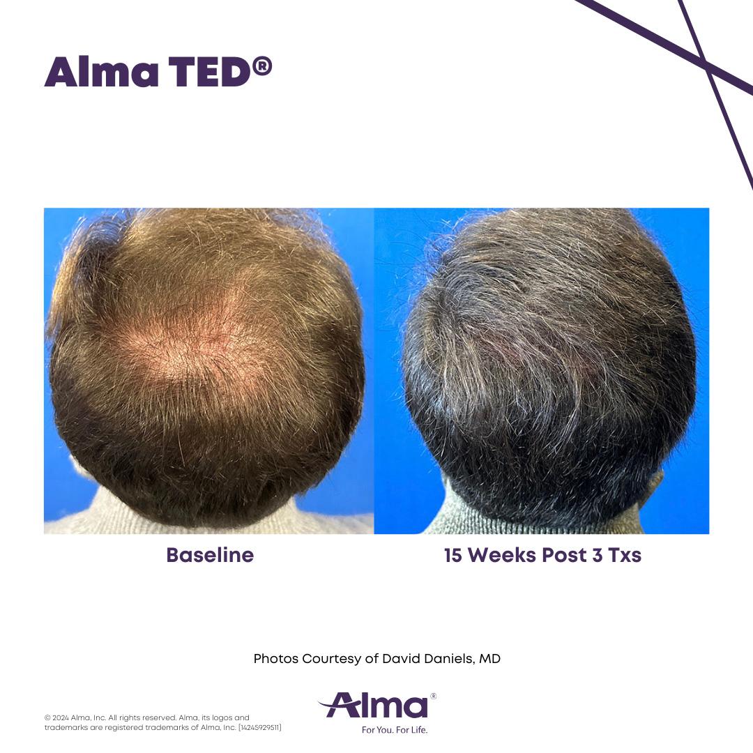 Alma TED Hair Restoration Results 3