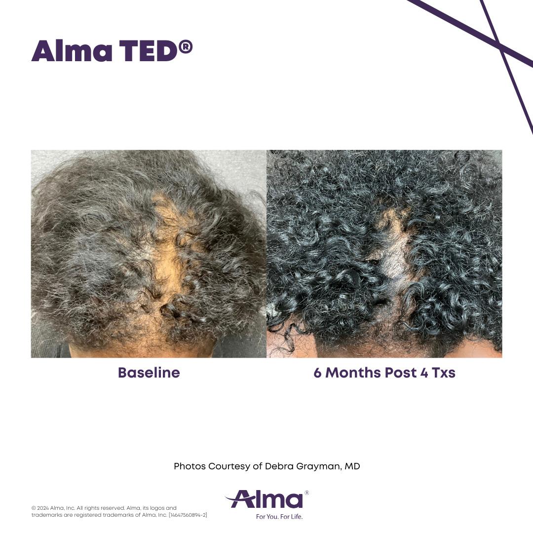 Alma TED Hair Restoration Results 4