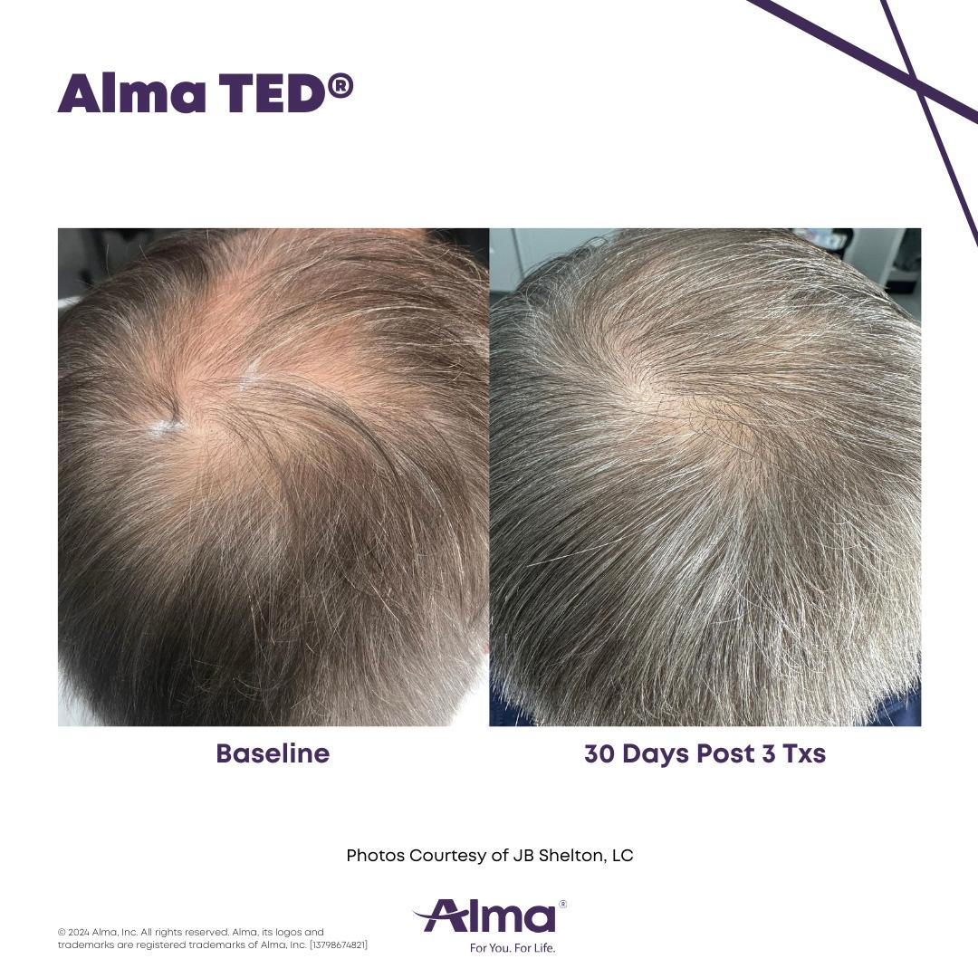 Alma TED Hair Restoration Results 5